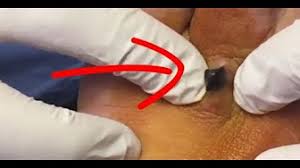 These bumps appear black because of oxidation and not because of the dirt. Blackheads On Legs Youtube