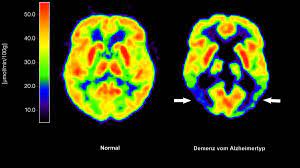 Demenz Studie Ist Alzheimer Ubertragbar Welt