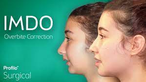 Some overbite cases range only a few millimeters, while more severe cases require jaw surgery to correct. Imdo For Teenagers Profilo Surgical