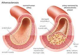 An Overview Of Atherosclerosis