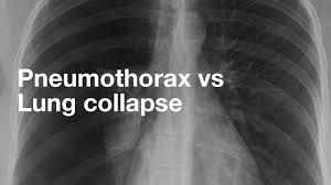 Oct 09, 2019 · pneumothorax or a collapsed lung, is a lung condition in which the lung(s) has been injured by infection, trauma, disease, cigarette smoking, and other medical problems. Pneumothorax Vs Lung Collapse Youtube