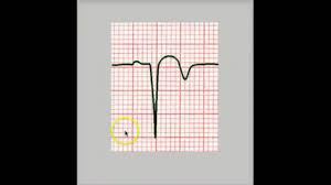 In the competency the most likely cause for pathological q waves will be myocardial infarction. Pathologic Q Wave Youtube