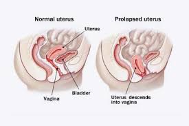 Pelvic Organ Prolapse The Pelvic Clinic