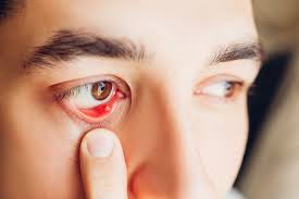 Check spelling or type a new query. Stye Inside The Eyelid Overview And More