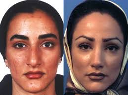 Iran Is Dubbed The Nose Job Capital Of The World Because So Much Of Their Body Is Covered The Nose Is Important Af Nose Job Rhinoplasty Cosmetic Surgery
