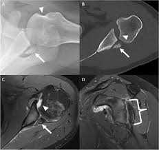 Image result for Shoulder Imaging