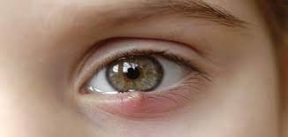 علاج التهاب جفن العين السفلي