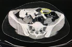 Endometriosis, a classic topic of gynaecological endocrinology and a condition that is challenging, is characterized by the presence of endometrial epithelial and stromal cells in. Cureus Abdominal Wall Endometriosis A Case Report