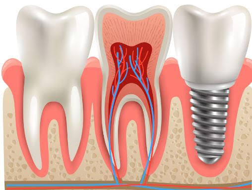 Dental Implants product image