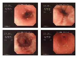 38 year old woman with esophagus ulcer; Herpetic Esophagitis In Immunocompetent Medical Student