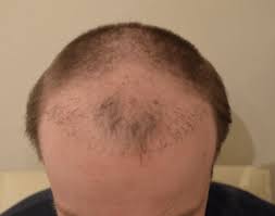 Im forum wird über themen diskutiert, die frauen und männer interessieren. Schlechte Verpfuschte Haartransplantation Mit Negativer Erfahrung Hairforlife