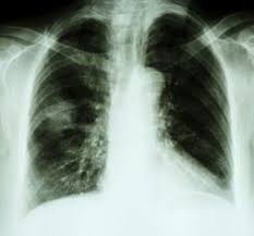 Nearly 40% of those newly diagnosed with lung cancer are already at stage 4 and have metastases, cancer that has spread to other parts of the body. 5 Centimeter Nodule
