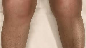 Image result for Septic Joint