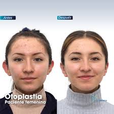 📌𝗖𝗶𝗿𝘂𝗴í𝗮 𝗱𝗲 𝗢𝘁𝗼𝗽𝗹𝗮𝘀𝘁𝗶𝗮 𝗰𝗼𝗻 𝘂𝗻 𝗺𝗲𝘀 𝗱𝗲  𝗲𝘃𝗼𝗹𝘂𝗰𝗶ó𝗻. ¿Alguna vez has sentido que tus orejas no están  simétricas? ¿Que una de ellas sobresale más que la otra? 🤔 La otoplastia  es una