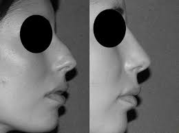 Dr michael veber, chirurgien plastique, vous reçoit en consultation dans son cabinet esthétique dans le très chic 6ième. Rhinoplastie A Lyon La Chirurgie Du Nez Par Le Dr Niforos