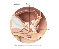 In these studies, a radionuclide dye is lymph nodes. Prostate Cancer Patient Information