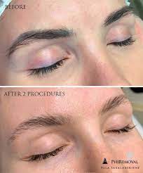They will not only give you the best results, they will also crucially make sure that the treatment you receive is safe and appropriate. Microblading Removal When And How To Do It Pmuhub