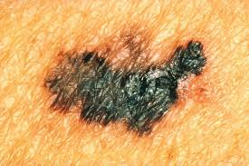 Skin cancer is by far the most common type of cancer. Spot The Differences Between A Mole And Skin Cancer