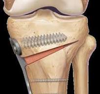 Opening Wedge Osteotomy System using ContourLock® HTO Plates