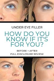 It's close to christmas and i'm embarrassed by the way i look. Should You Get Under Eye Filler Beauty The Glitter Gospel