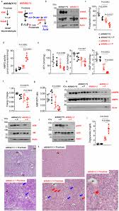 Image result for Hereditary Fructose Intolerance