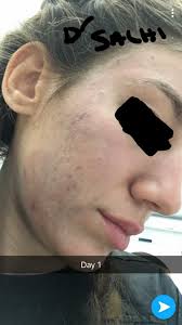 التقشير الكيميائي للوجه جميع docteur salhi dermatologue facebook