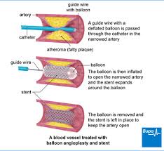 It is a standard treatment for narrowed or blocked doctors also refer to angioplasty as percutaneous coronary intervention, or pci. Angioplasty Of The Leg Arteries Health Information Bupa Uk