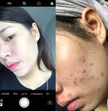 📍ສຳລັບໃຜທີ່ມີປັນຫາຜິວ📍💁🏻ບໍ...