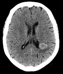 Introduction multiple sclerosis is characterized by the presence of primary demyelinating lesions in the central nervous system. Lo Que Debes Saber Sobre La Resonancia Magnetica En La Em Blog Esclerosis Multiple Susosantiago