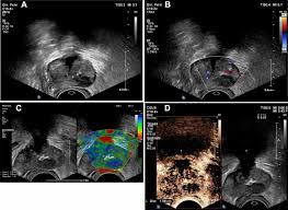 Skip to content search menu this is cancer.net's guide to prostate cancer. Prostate Cancer Ultrasound Is Still A Valid Tool Springerlink