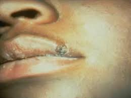 Image result for syphilis ulcer