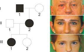 Spectrum Of Novel Mutations Found In Waardenburg Syndrome Types 1 And 2 Implications For Molecular Genetic Diagnostics Bmj Open