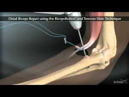 Pin On Bicep Tendon Surgery