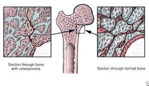 Osteoporosis Treatment Signs Symptoms