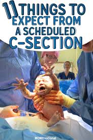 Pin On C Section Recovery