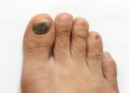 This can be due to friction during. Blood Blister On Foot Beaver Valley Foot Clinic