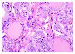 Maybe you would like to learn more about one of these? Histology Of Papillary Thyroid Carcinoma Ptc Showing Nuclear Changes Download Scientific Diagram