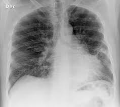 Bone pain can cause a dull or deep ache in a bone or bone region (e.g., back, pelvis, legs, ribs, arms). Lung Cancer With Bone Metastases Radiology Case Radiopaedia Org