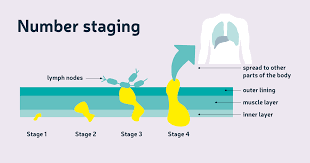 The earliest stage pancreas cancers are stage 0 (carcinoma in situ), and then range from stages i (1) through iv (4). Staging Grading Diagnosis About Bowel Cancer Bowel Cancer Uk