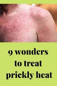 9 Wonders To Treat Prickly Heat Prickly Heat Treat Prickly Heat Prickly Heat Rash