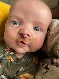 Meet Emmett. He's our youngest son and he is a proud Little Victor of Mott  Children's Hospital. He is a cleft baby AND a hydrocephalus baby and in his  2.5 years has