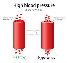 High Blood Pressure (Hypertension) Symptoms & Treatment | Dr Raghu