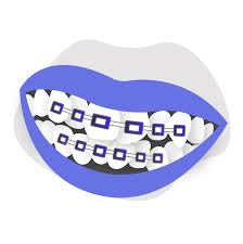 But, the average braces time to wear them is normally from 18 months to 2 complete years. Can Braces Correct Teeth Crowding In Adults Smile Prep