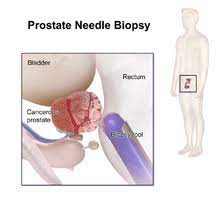 Prostate Cancer Wikipedia