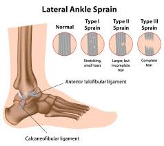 Ankle Sprains Sports Related Injuries Sports Medicine Sprained Ankle Sprain Ankle Ligaments