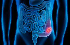 Turning of the head towards a light source (caused by decreasing vision). Stage 3 Colon Cancer Symptoms Diagnosis And Treatment