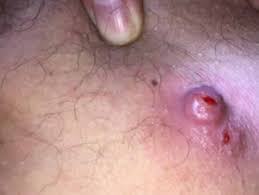Bumps on your vagina 11 vaginal lumps and bumps explained. Ingrown Hair Infected Ingrown Hair Cyst In Pubic Area