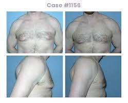 Due to genetics, use of certain medications, or other unspecified reasons, some men develop the. Male Breast Reduction Surgery Taylor Plastic Surgery