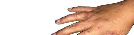 Image result for human scabies