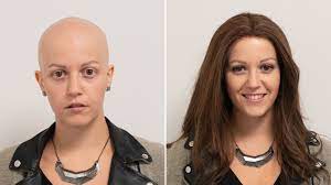 Alopecia areata is a type of hair loss that affects about 2% of the population; Alopecia Universalis Wavy Wig Transformation Mit Perucke Hairsystems Heydecke Youtube